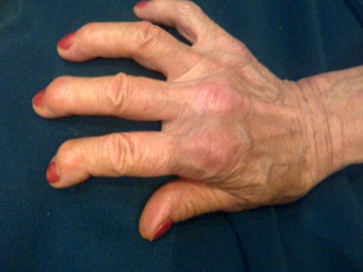 Mana blanda a Mamei, chinuita de poliartrita reumatoidala ...